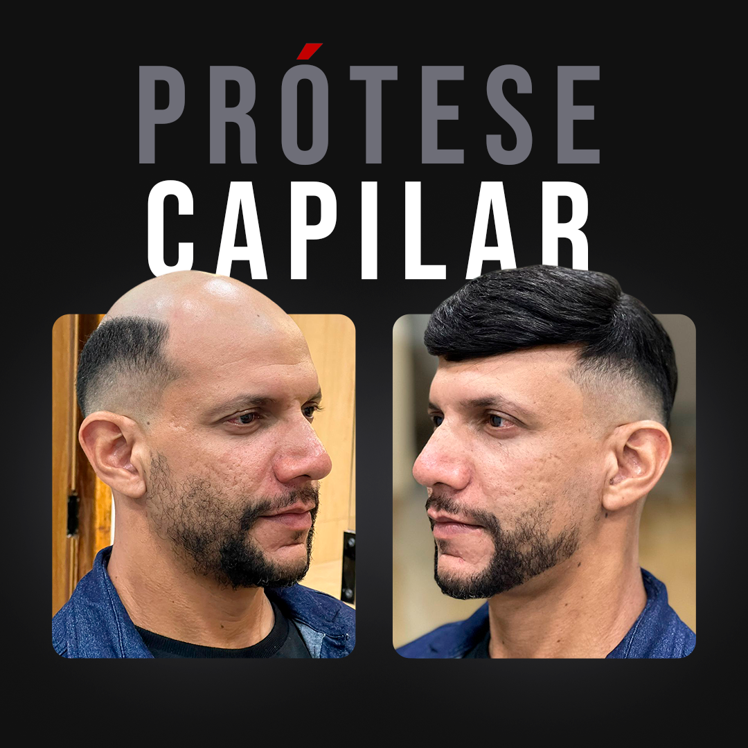 hair-prosthesis